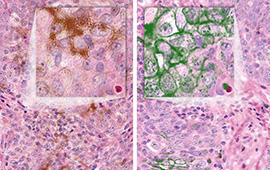 Head & Neck Squamous Cell Carcinoma: PD-L1 by IHC (1)
